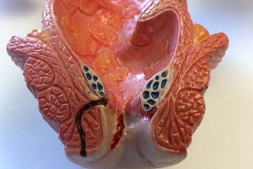 twin pregnancy and haemorrhoids
