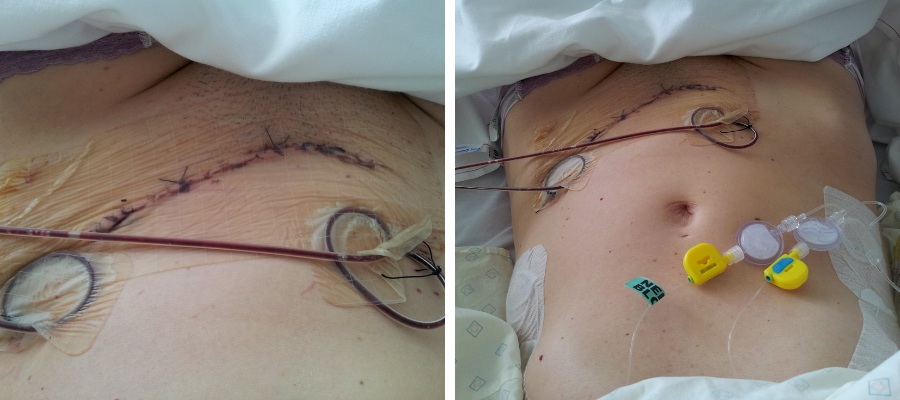 Desmoid Tumour after twin pregnancy. Desmoid Tumour and twins