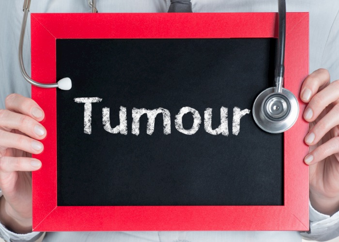 Desmoid Tumour after twin pregnancy. desmoid tumour