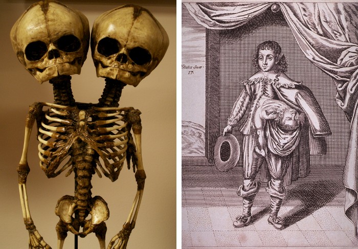 Survival Rate Of Conjoined Twins