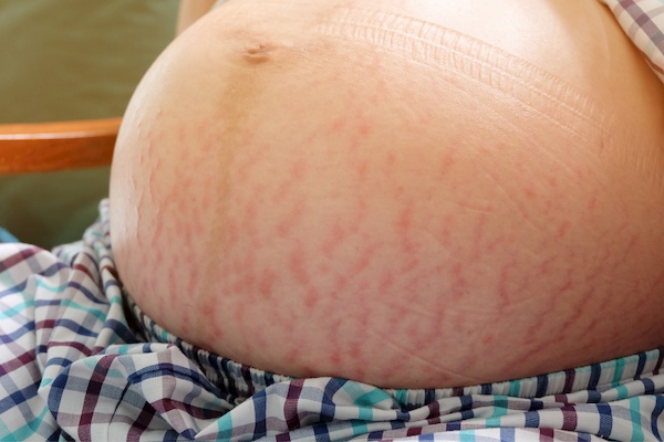 Stretch marks with twin or triplet pregnancy pregnant with twins and stretchmarks