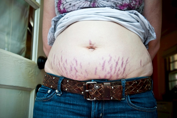 Stretch marks with twin or triplet pregnancy preventing stretchmarks