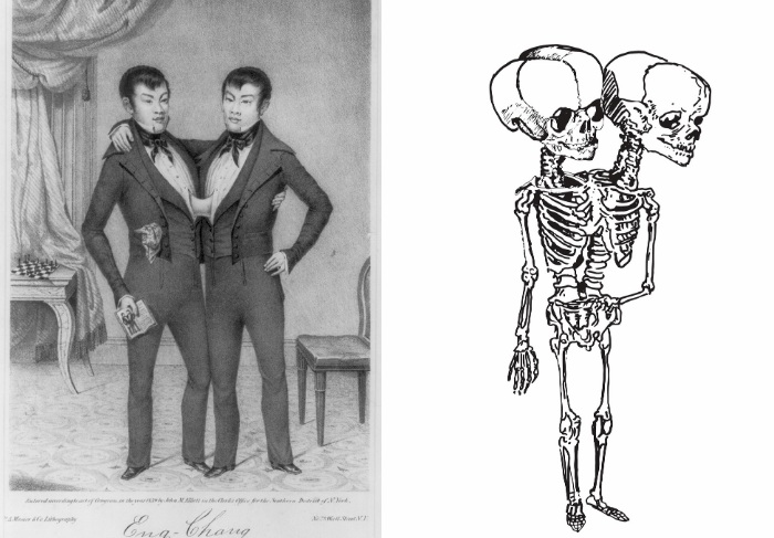 rate of conjoined twins