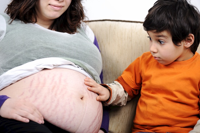 Stretch marks with twin or triplet pregnancy stretchmarks and triplets