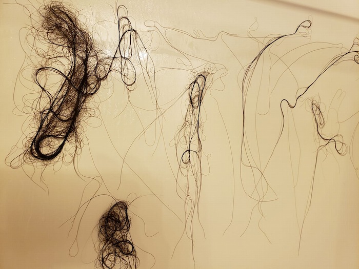 Post-partum hair loss after twins or triplets hair loss after twins