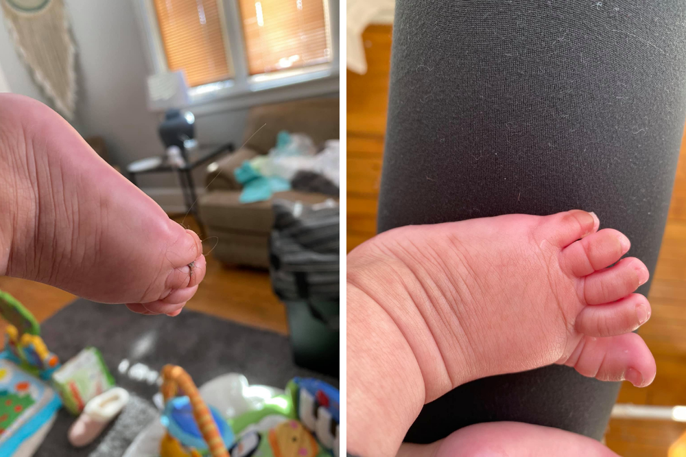 Post-partum hair loss after twins or triplets hair wrapped around toe