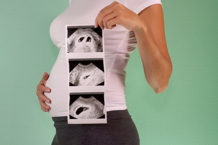 Vanishing Twin Syndrome pregnant with twins and one dies