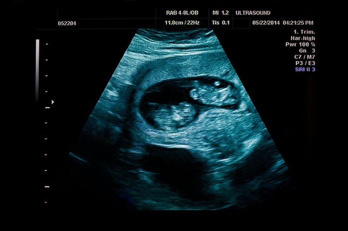 Vanishing Twin Syndrome vanishing twin causes