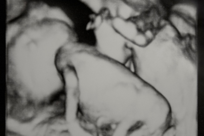 Reasons people decide against finding out gender of twins or more reasons not to find out gender of triplets