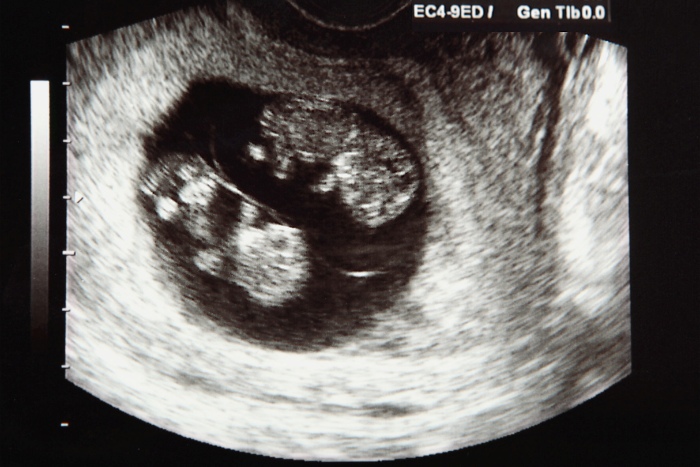 excitement when find out pregnant with twins