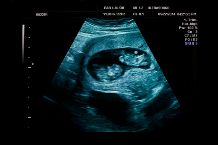 Identical Twins Opposite Genders