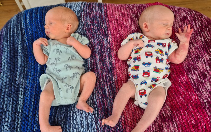 One identical twin with clubfoot but not the other One identical twin with clubfoot