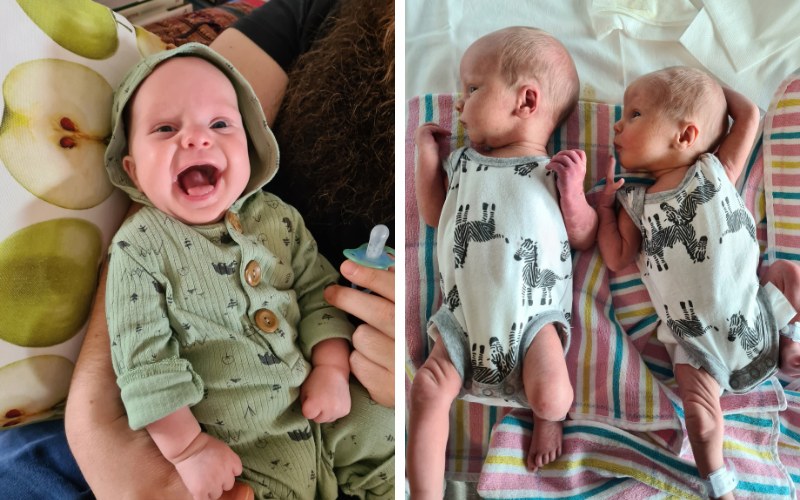 One identical twin with clubfoot but not the other clubfoot in one twin