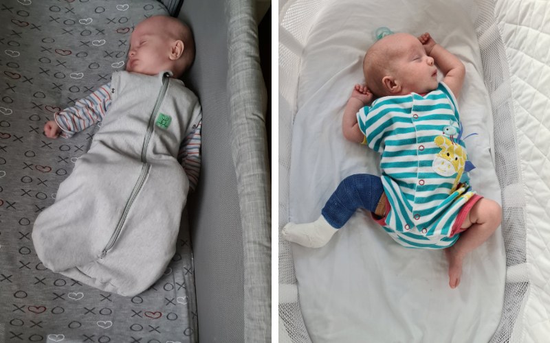 One identical twin with clubfoot but not the other medical differences in identical twins