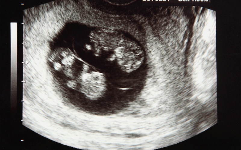 “Embracing” a twin pregnancy not able to Embracing a twin pregnancy