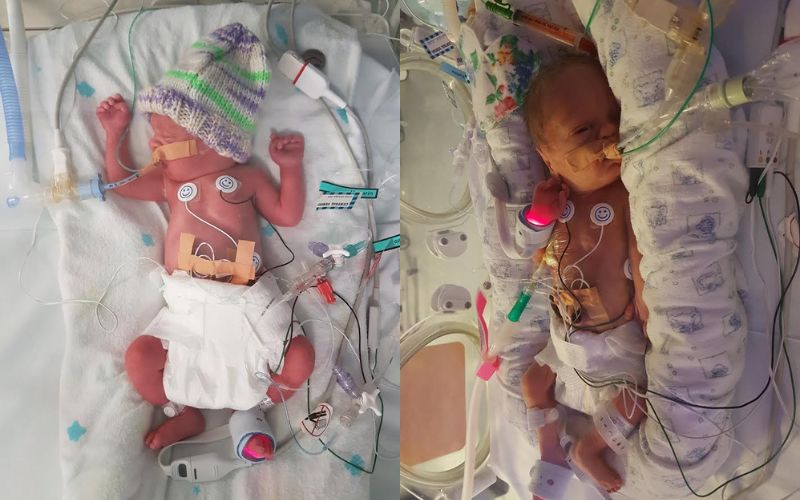 Triplets (with surviving fraternal boy twins) born at 29+4 triplets with surviving fraternal twins