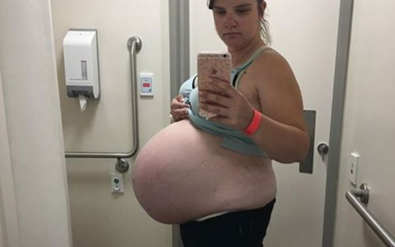 A remote area pregnancy - pregnant with twins Remote area pregnancy