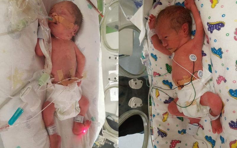 Triplets (with surviving fraternal boy twins) born at 29+4 Surviving fraternal twins from triplets