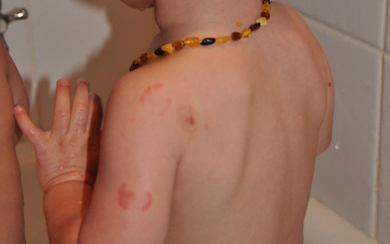 Twins who bite: Biting, and how to minimise it Triplets who bite each other