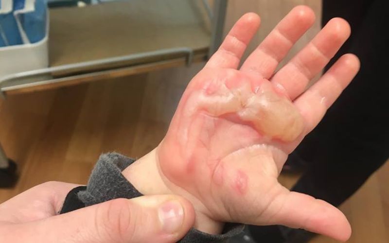 burnt hand caused by heater