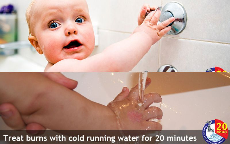 burns in children tips