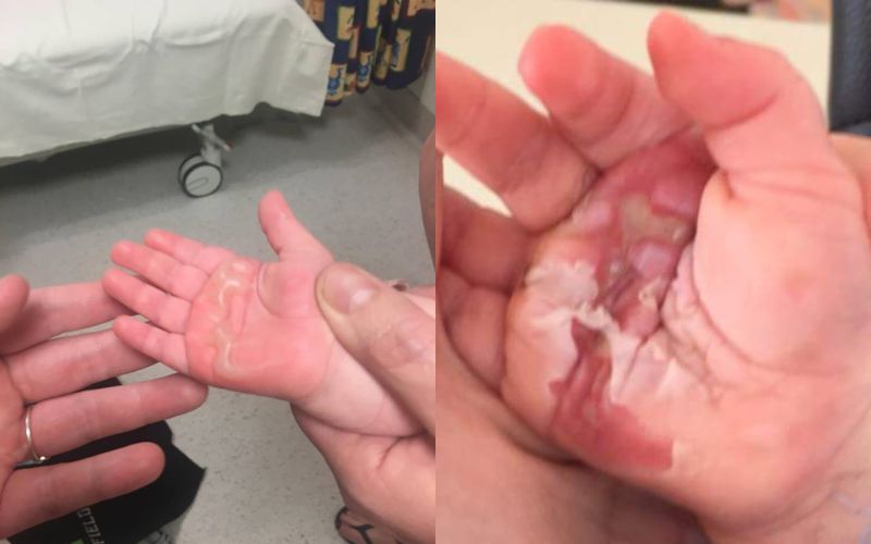 burns in children