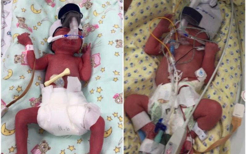 Fraternal girl/boy twins - born at 29+6 fraternal girl boy twins born 30 weeks