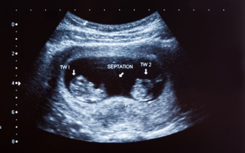 nicknames for twin in utero
