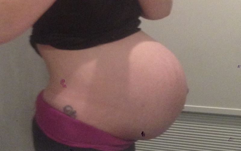 Surprised by a cleft lip and palate in one twin at birth 43 and pregnant with twins
