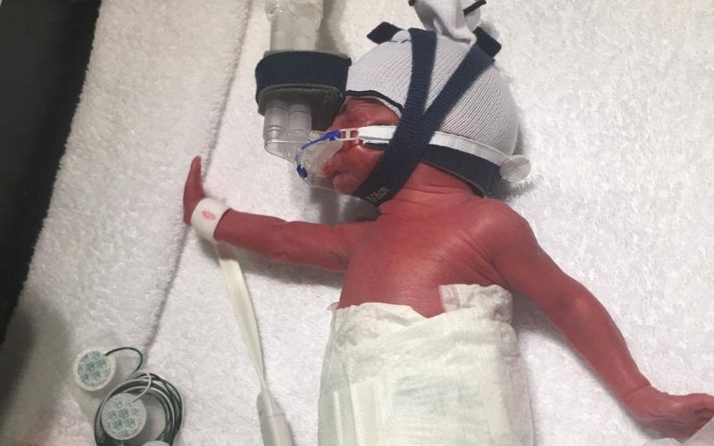 Born at 28 weeks - Twin Birth Story born at 28 weeks twins