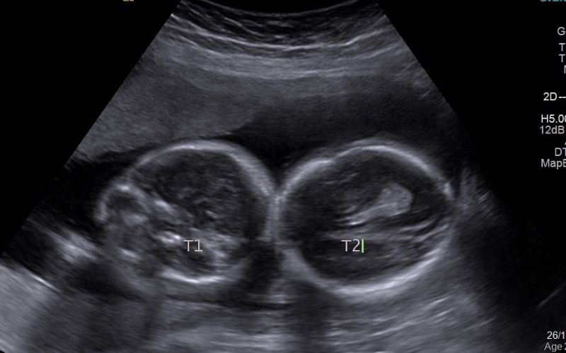 Surprised by a cleft lip and palate in one twin at birth cleft palate and lip twins