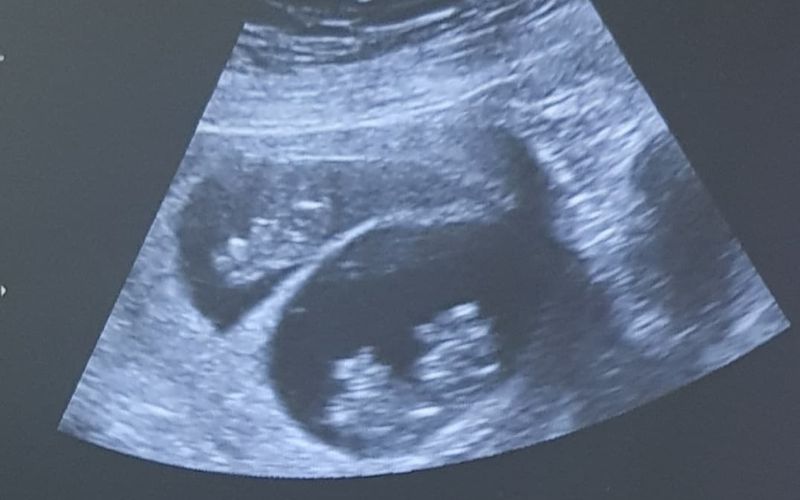 Finding out we were pregnant with twins pregnant with twins