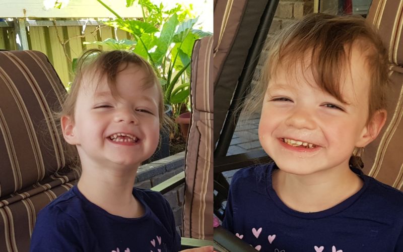 Life today of a DCDA twins born at 32 weeks