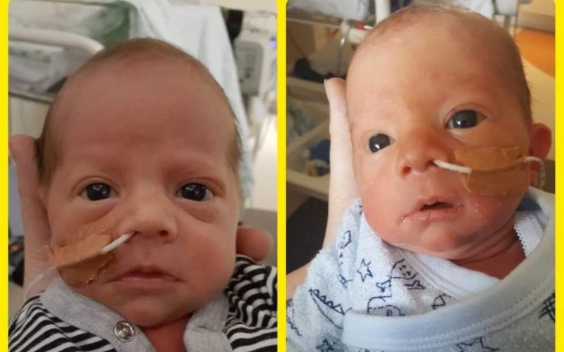 Pre existing heart condition and pregnant with twins. Twins born 33 weeks and 5 days. Twins born at 33 weeks