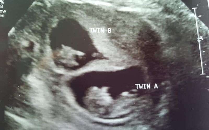Pre existing heart condition and pregnant with twins. Twins born 33 weeks and 5 days. pregnant with twins 8 weeks