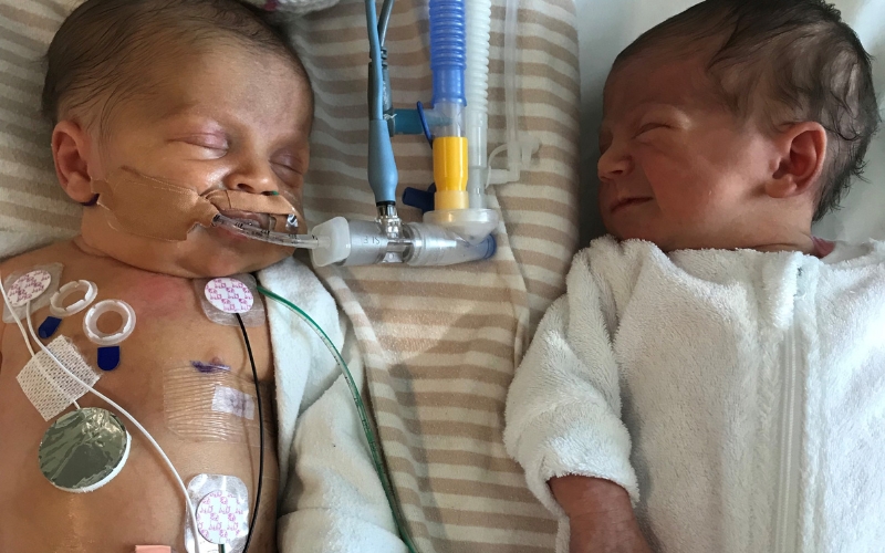One of our twins was born with a Congenital Diaphragmatic Hernia. twins and Congenital Diaphragmatic Hernia