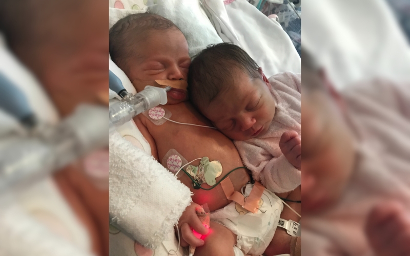 One of our twins was born with a Congenital Diaphragmatic Hernia. twins and a twins Congenital Diaphragmatic Hernia
