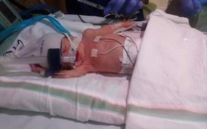Full placenta abruption with twins. My harrowing twin birth story. Placental abruption twins