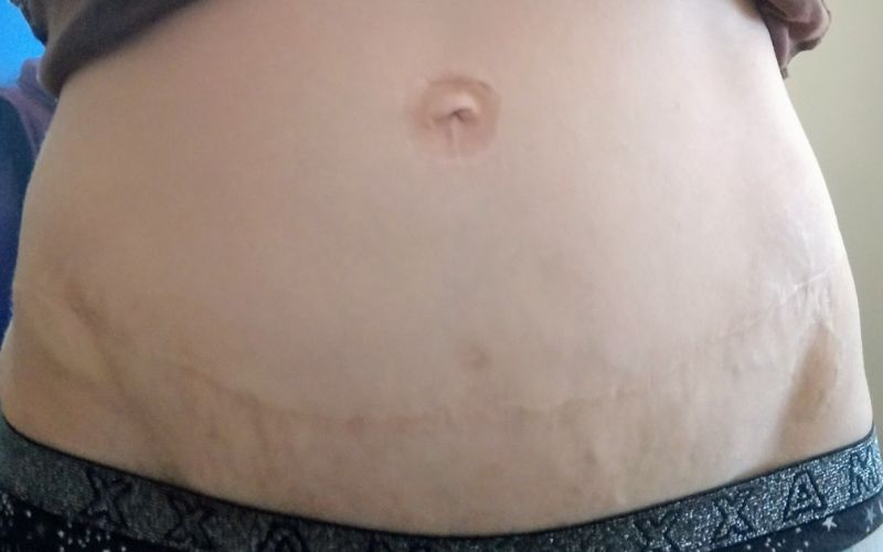 Hernias, abdominal separation and abdominoplasty after twins hernia after twins