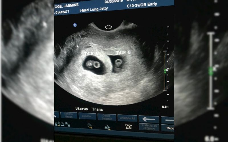 twin ultrasound 6 weeks
