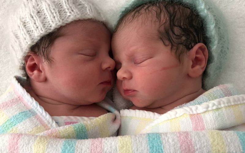 Twin Pregnancy and Bell's Palsy twins born at 37 weeks rotated