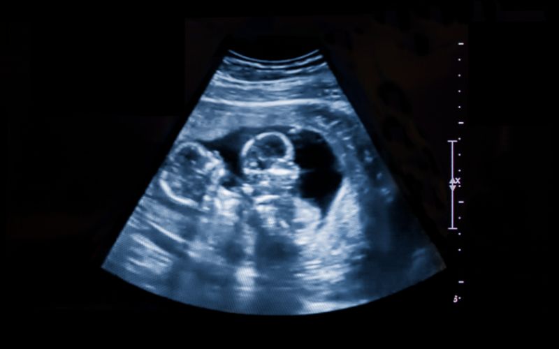 Chances of having twins or triplets: Why Australia is seeing a rise in multiple births Chances of having twins or triplets in australia