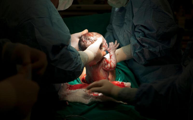 Recovery After a C-Section for Twins or Triplets: What You Need to Know recovery after a C-Section for Twins or Triplets